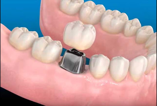 Clínica Dental Casher - Dentista Alicante
